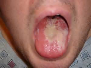 infección por candida albicans