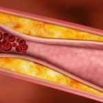 Ateroesclerosis-un-mal-que-consume-las-arteras-2016