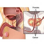 cancer-prostata