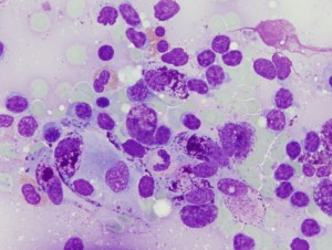 Mastocitosis sistémica asociada a enfermedad hematológica clonal no mastocítica (LLC)