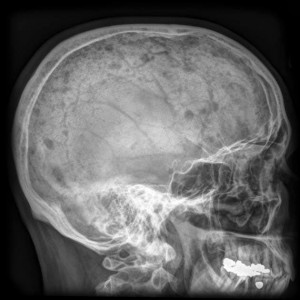 Radiografía del cráneo tomado de la cara muestra los hallazgos típicos de mieloma múltiple los que son múltiples agujeros sacabocados