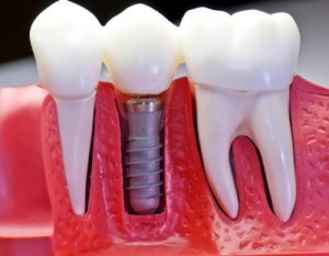 Recubrimiento implantes dentales