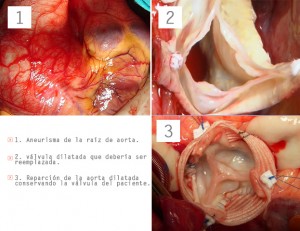 Tratamiento quirúrgico de aneurismo de la aorta