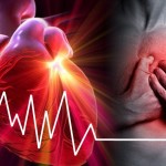 infarto del miocardio