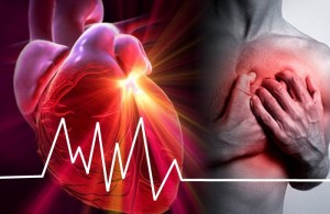 infarto del miocardio