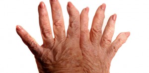 artrosis-artritis