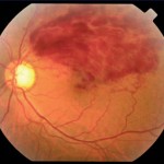 enfermedad vascular de la retina