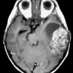 neuroblastoma