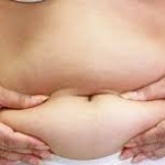 obesidad abdominal