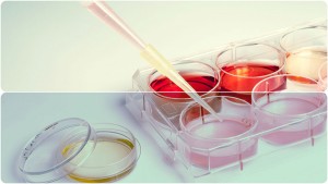  test genético permitirá diagnosticar leucemias de células B