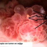 Cancer de vejiga por cistoscopia_1