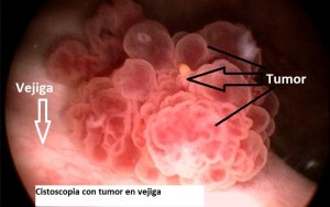 Cancer de vejiga por cistoscopia_1