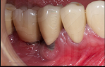 periimplantitis dental