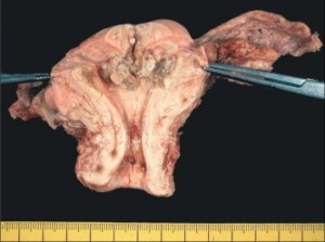 cáncer de endometrio