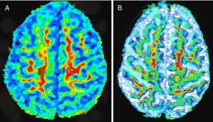 Mapas de color de anisotropía fraccional en axial de un sujeto sano y un paciente con esclerosis lateral amiotrófica