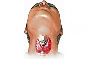 hipotiroidismo1