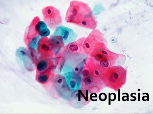 neoplasias-1-638
