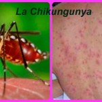 Fiebre-Chikungunya