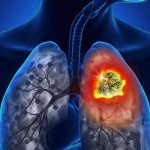 Un 30 % de los casos avanzados de tumor pulmonar ya se registran en mujeres 