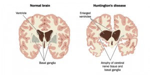 Huntingtons-disease-brain-cannabis-info