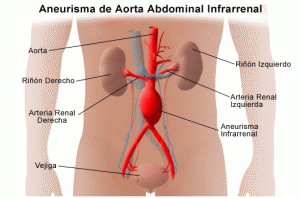 aneurisma de aorta abdominal