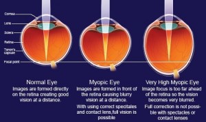 high myopia