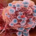 metastasis cancer de mama