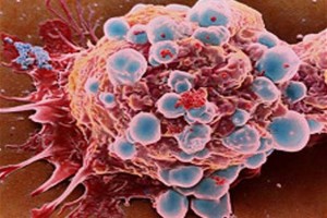 metastasis cancer de mama