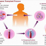 trasplante autologo1