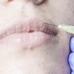 Tratamiento-aumento-labios-Clodia