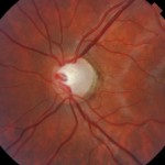 Glaucoma_ANGULOABIERTO-1024x680