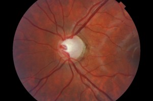 Glaucoma ángulo abierto