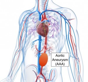 aneurisma de aorta abdominal1