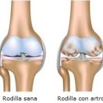 artrosis-rodilla1