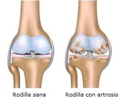 artrosis-rodilla1