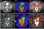 La tomografía con fluoruro de sodio predice la progresión del aneurisma aórtico abdominal