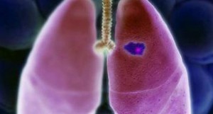 cáncer de pulmón no microcítico