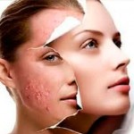 acne-cicatrices