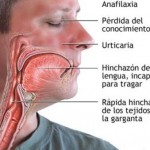 angioedema
