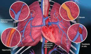 mal-funcionamiento-hipertension-pulmonar3