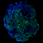 Un nuevo diseño de inmunotoxina aumenta su eficacia contra el cáncer de colon