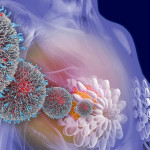 Cáncer de mama