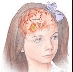 tumores cerebrales pediátricos
