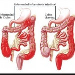Enfermedad Inflamatoria intestinal