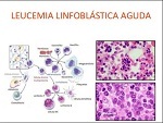Leucemia linfoblástica aguda