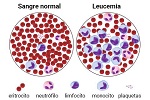 Leucemia (tipos)