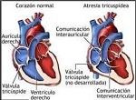cardiopatía congénita