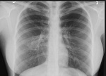 malformaciones arteriovenosas pulmonares