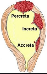 tipos de placenta
