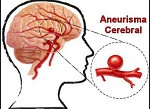 aneurisma cerebral